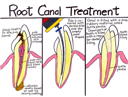 ROOT CANAL TREATMENT IN BHAGALPUR