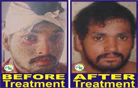 PSORCOSIS TREATMENT CENTRE IN BHAGALPUR