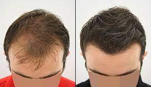 BEST HAIR TRANSFORMATION CLINIC IN RANCHI