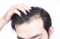 HAIR RESTORATION NEAR DHURVA RANCHI
