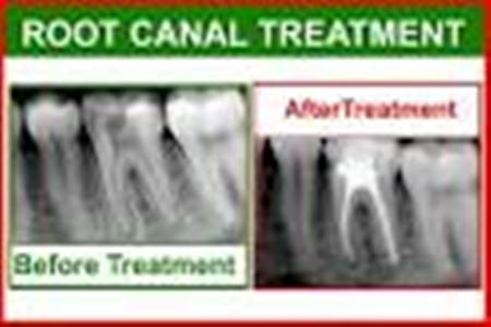 ROOT CANAL TREATMENT IN PATNA