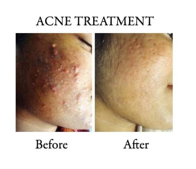 ACNE AND ACNE SCARS TREATMENT IN RANCHI