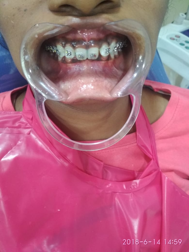 dental clinic in barkakana