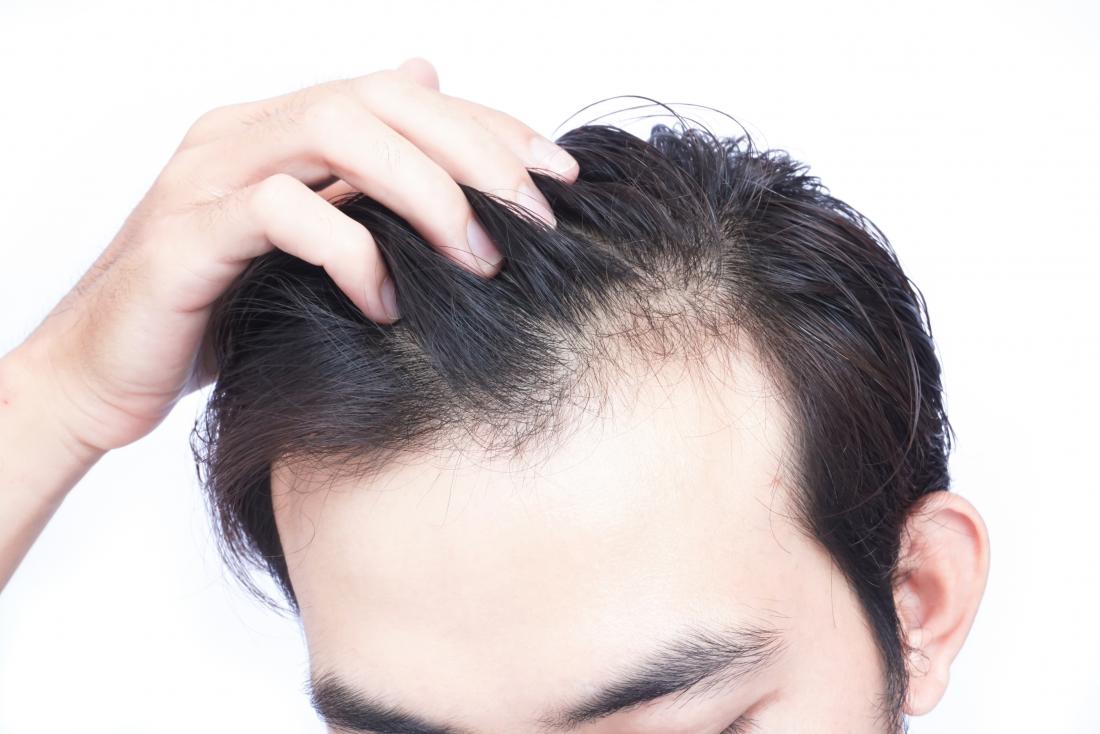 HAIR RESTORATION NEAR DHURVA RANCHI | KAV DENTAL COSMETIC & HAIR TRANSPLANT  CLINIC