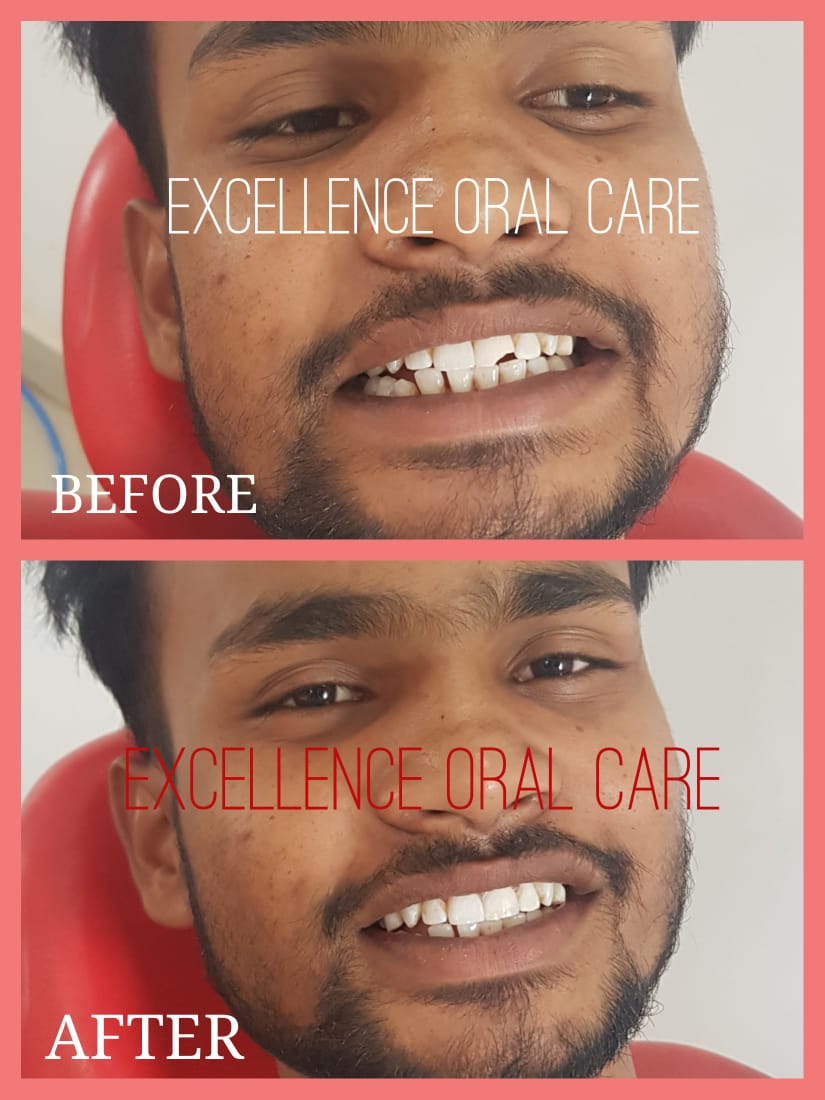 EXCELLENCE DENTAL CARE IN HAZARIBAGH